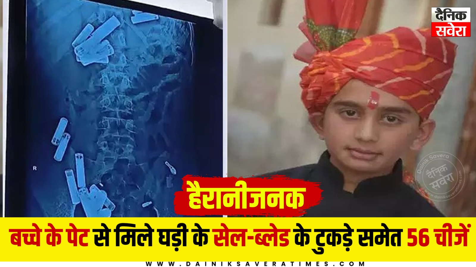 नौवीं कक्षा के छात्र के पेट से मिले घड़ी में लगने वाले सेल, ब्लेड के टुकड़े समेत 56 चीजें, ऑपरेशन करते वक्त डाक्टर हुए हैरान