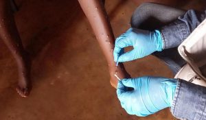 Africa में कहर बरपा रहा Mpox, 70 हजार के करीब पहुंची पीड़ितों की संख्या