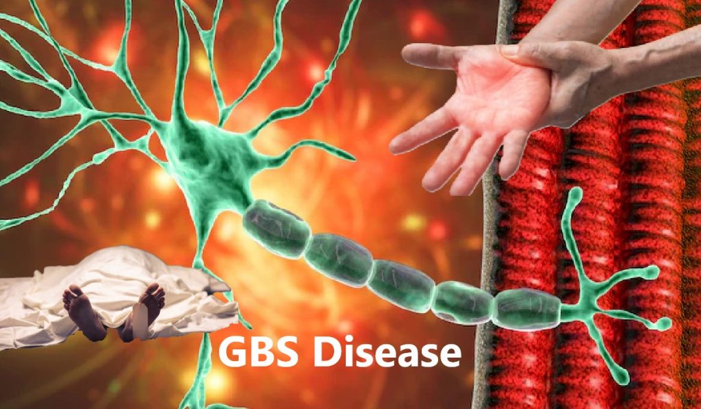 GBS Disease