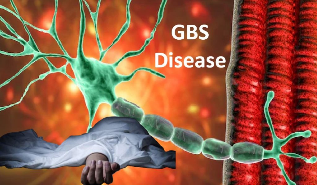 GBS Disease