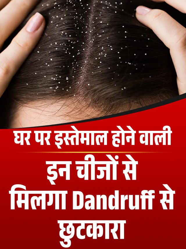 घर पर इस्तेमाल होने वाली इन चीजों से मिलगा Dandruff से छुटकारा