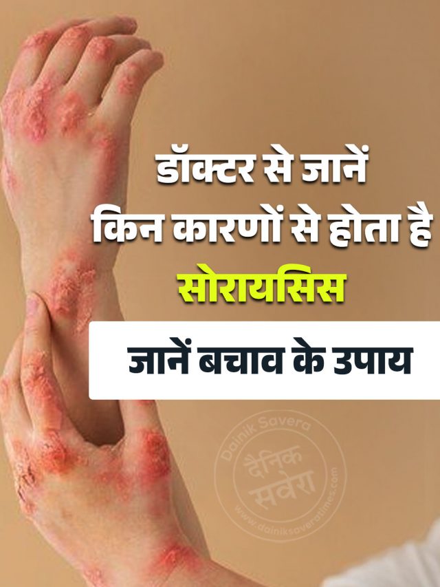 डॉक्टर से जानें किन कारणों से होता है सोरायसिस, जानें बचाव के उपाय