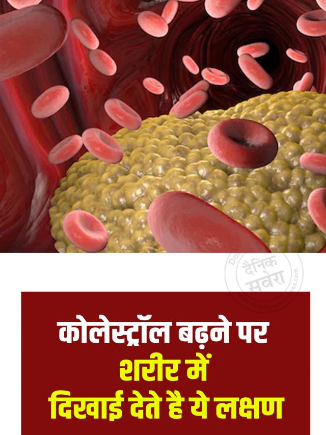 कोलेस्ट्रॉल बढ़ने पर शरीर में दिखाई देते है ये लक्षण