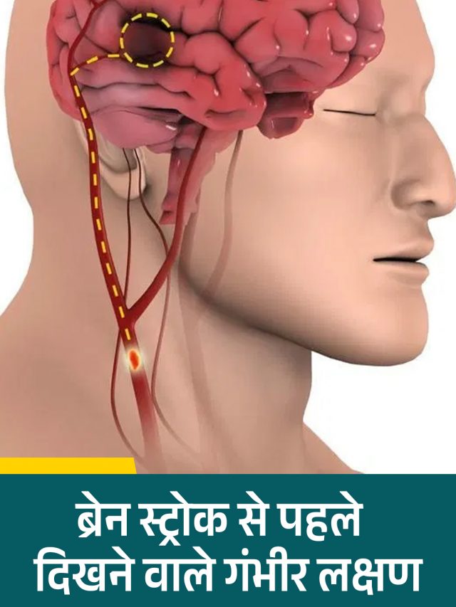ब्रेन स्ट्रोक से पहले दिखने वाले गंभीर लक्षण