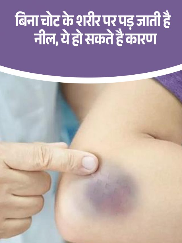 बिना चोट के शरीर पर पड़ जाती है नील, ये हो सकते है कारण