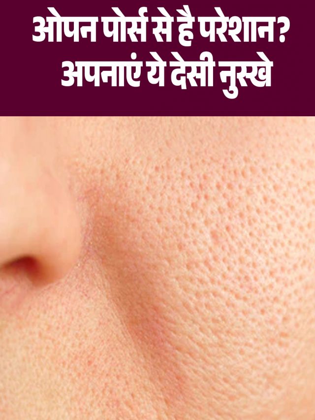ओपन पोर्स से है परेशान? अपनाएं ये देसी नुस्खे