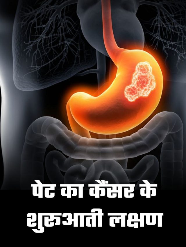 पेट का कैंसर के शुरूआती लक्षण
