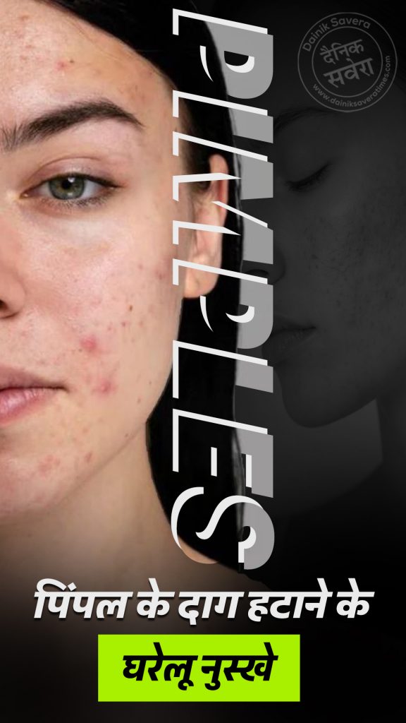 Home remedies to remove pimple marks