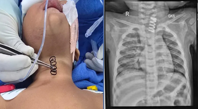 AIIMS के डॉक्टरों ने बच्चे की फूड पाइप से 2 इंच लंबा मैटल स्प्रिंग निकाल बचाई जान