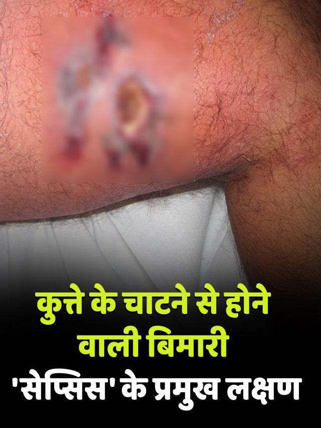 कुत्ते के चाटने से होने वाली बिमारी ‘सेप्सिस’ के प्रमुख लक्षण