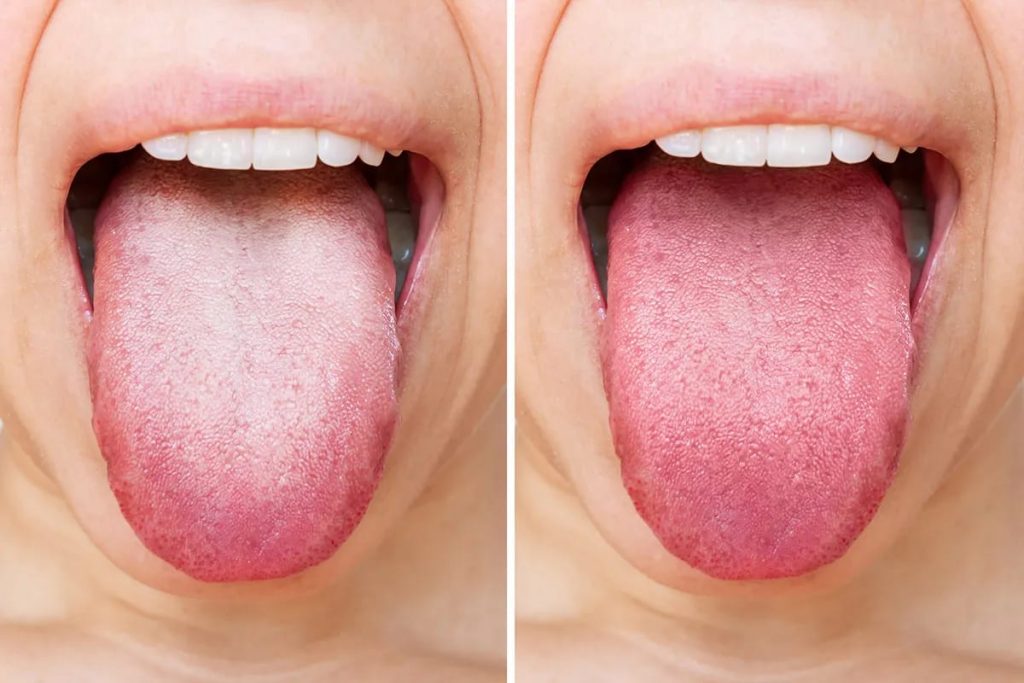 white tongue internal health issues
