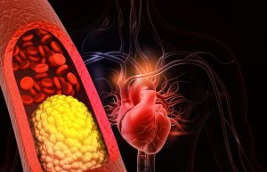 Ayurveda cholesterol diet lifestyle