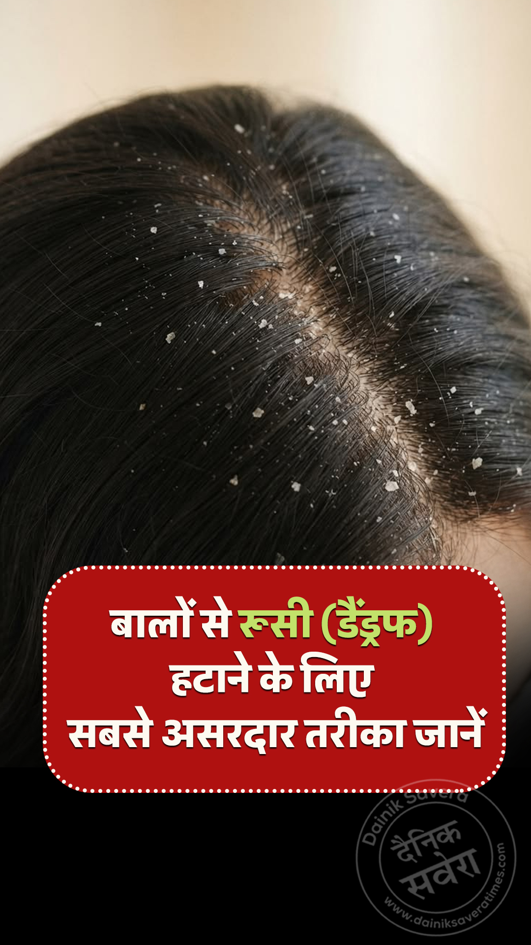 बालों से रूसी (डैंड्रफ) हटाने के लिए सबसे असरदार तरीका जानें