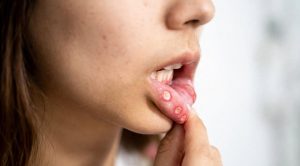 Oral Health: मुंह में छाले होने पर कान में क्यों होने लगता है दर्द? जानिए दोनों के बीच क्या है कनेक्शन