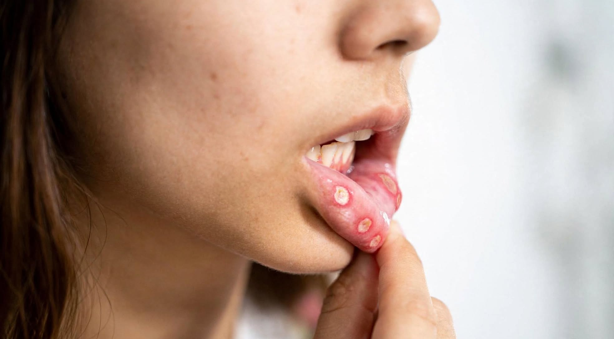 Oral Health: मुंह में छाले होने पर कान में क्यों होने लगता है दर्द? जानिए दोनों के बीच क्या है कनेक्शन
