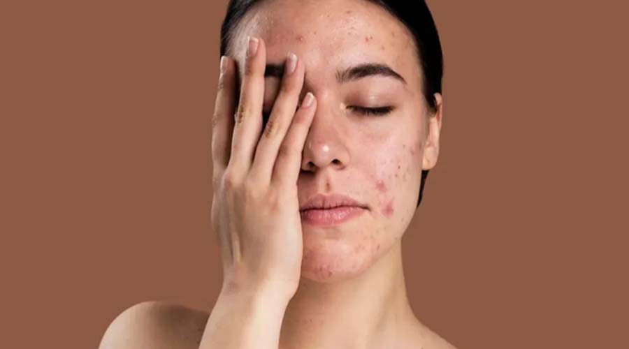 चेहरे से भूरे दाग-धब्बे हटाने के लिए अपनाएं ये 3 तरीके, जानें स्किन केयर टिप्स