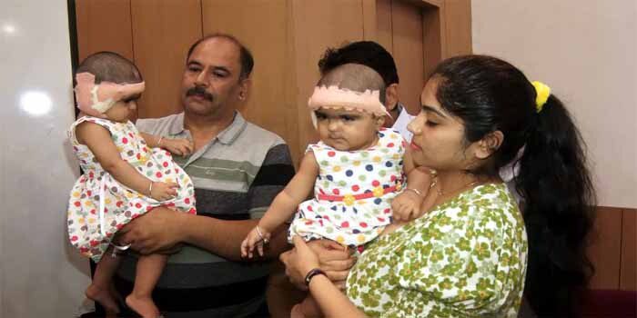 सुनने में असमर्थ 11 माह की जुड़वां बच्चियों को लुधियाना के डॉक्टरों ने दी नई जिंदगी